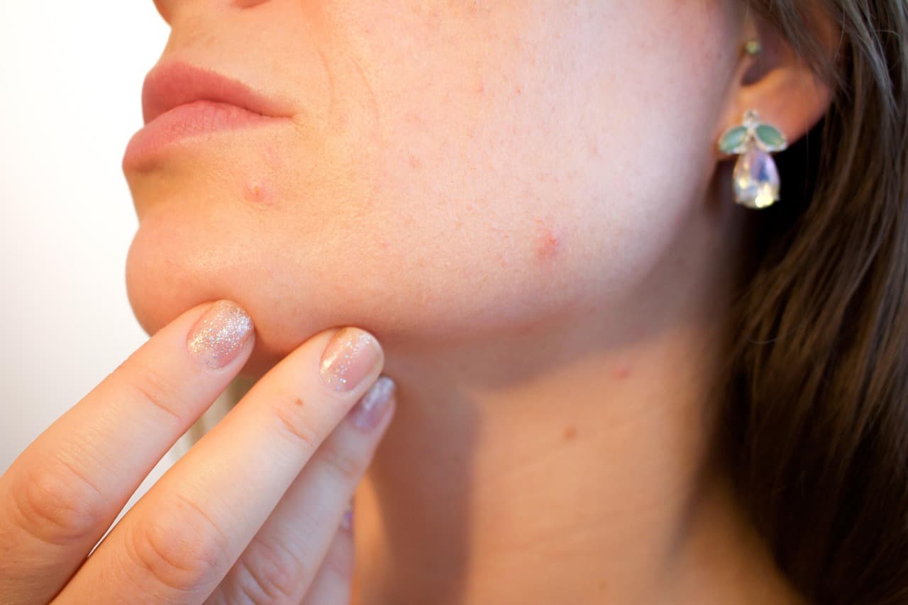 Acne bij volwassenen: oorzaken & behandeling