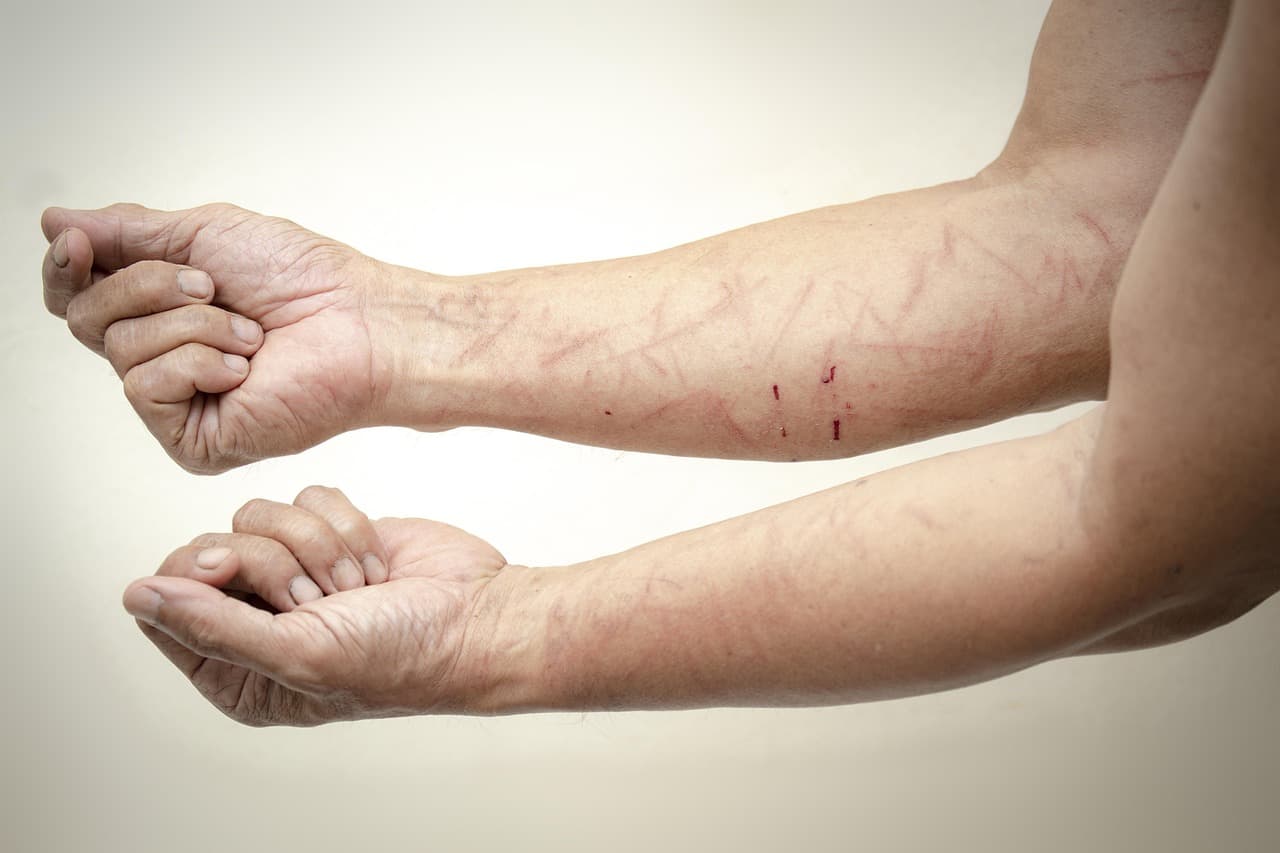 Littekens: Oorzaken, Types en Behandelmogelijkheden